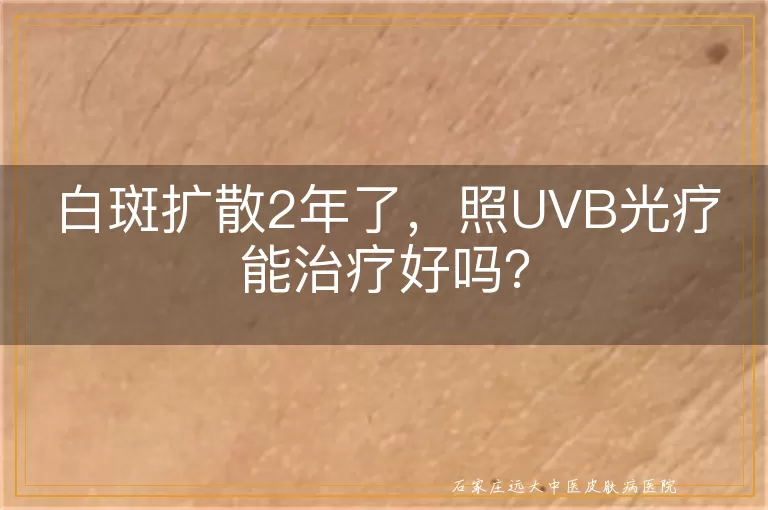 白斑扩散2年了，照UVB光疗能治疗好吗？