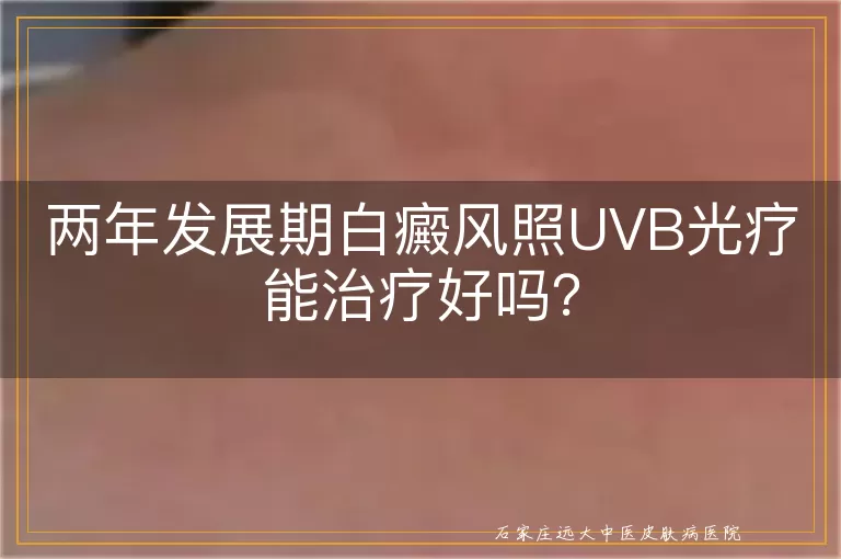 两年发展期白癜风照UVB光疗能治疗好吗？