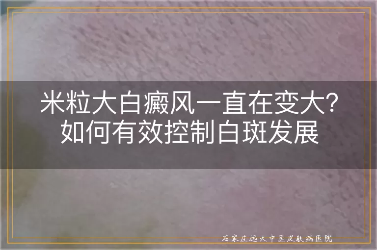 米粒大白癜风一直在变大？如何有效控制白斑发展