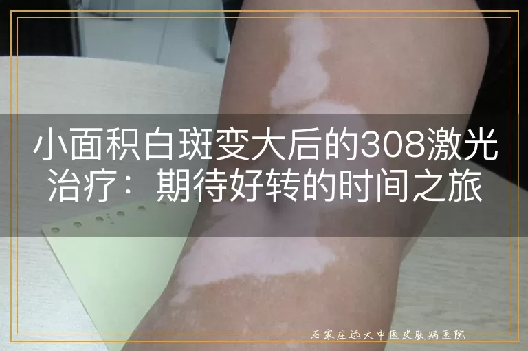 小面积白斑变大后的308激光治疗：期待好转的时间之旅