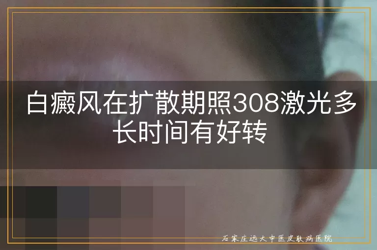 白癜风在扩散期照308激光多长时间有好转