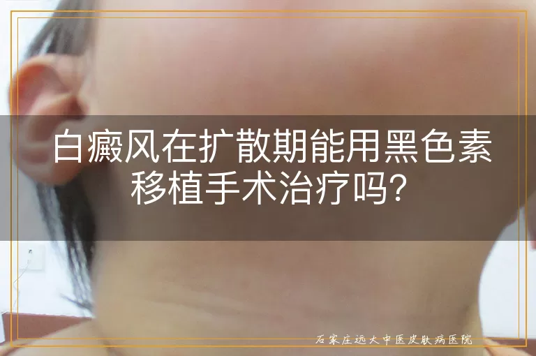 白癜风在扩散期能用黑色素移植手术治疗吗？