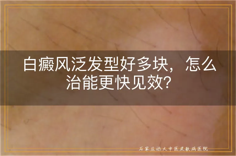 白癜风泛发型好多块，怎么治能更快见效？