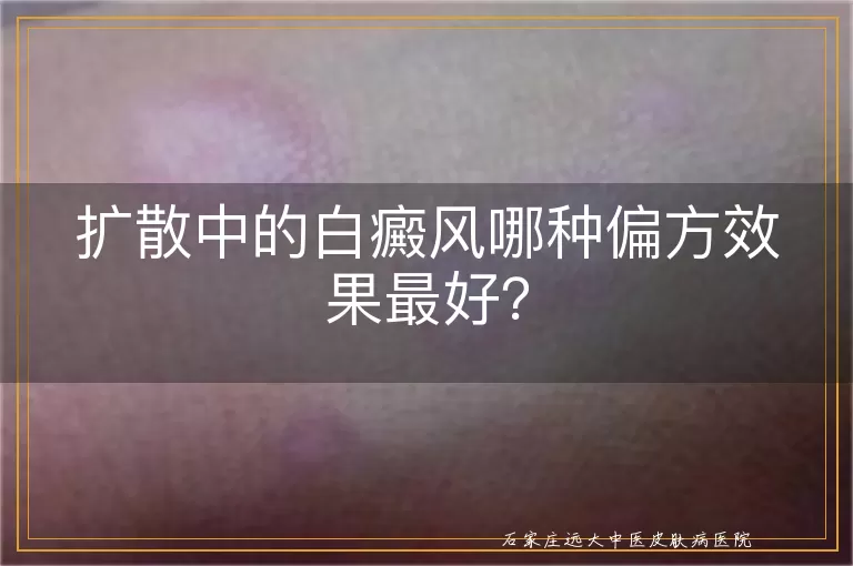 扩散中的白癜风哪种偏方效果最好？