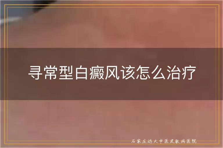 寻常型白癜风该怎么治疗