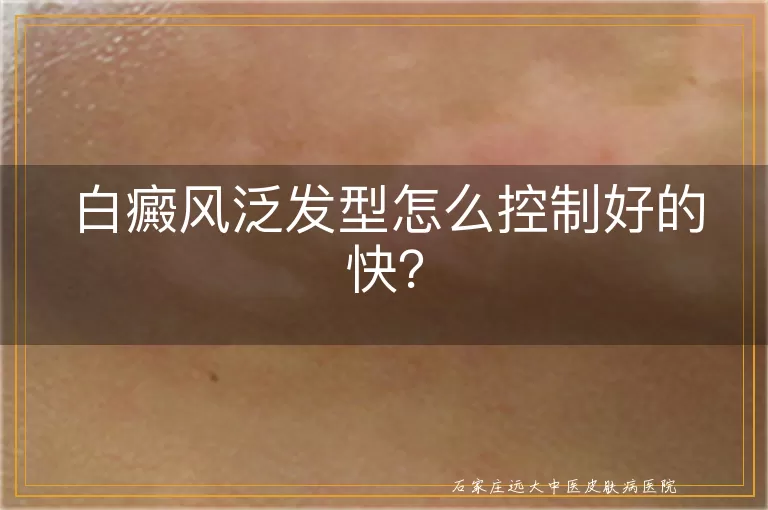 白癜风泛发型怎么控制好的快？