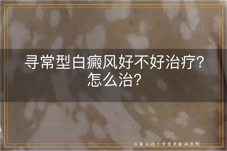 寻常型白癜风好不好治疗？怎么治？