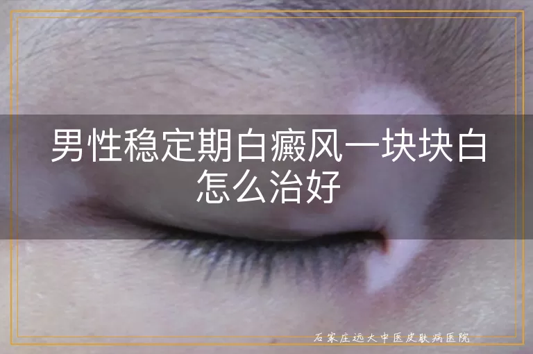 男性稳定期白癜风一块块白怎么治好