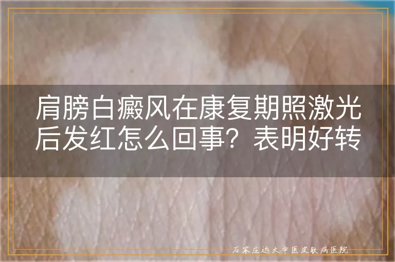 肩膀白癜风在康复期照激光后发红怎么回事？表明好转吗？