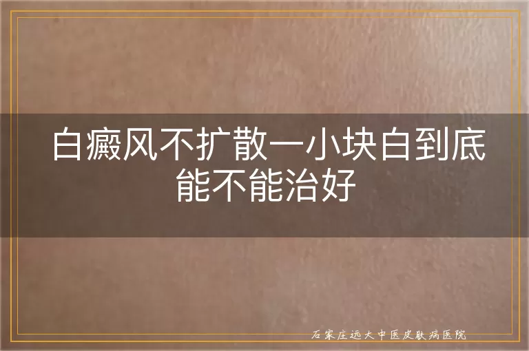 白癜风不扩散一小块白到底能不能治好