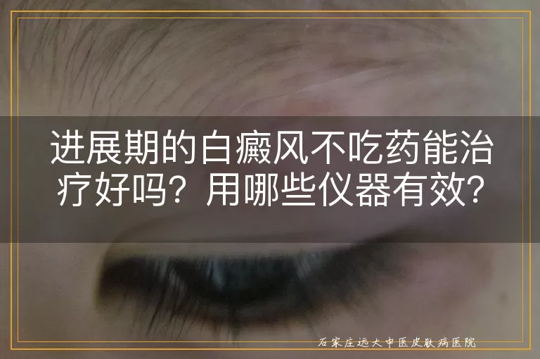 进展期的白癜风不吃药能治疗好吗？用哪些仪器有效？