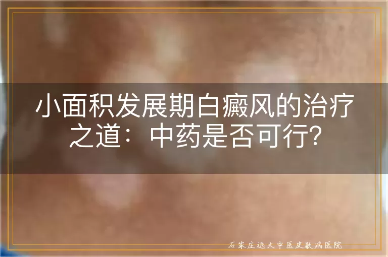 小面积发展期白癜风的治疗之道：中药是否可行？