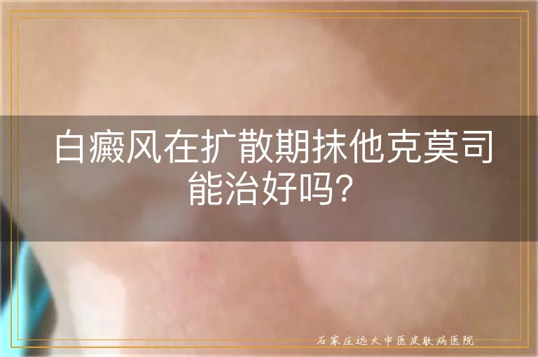 白癜风在扩散期抹他克莫司能治好吗？