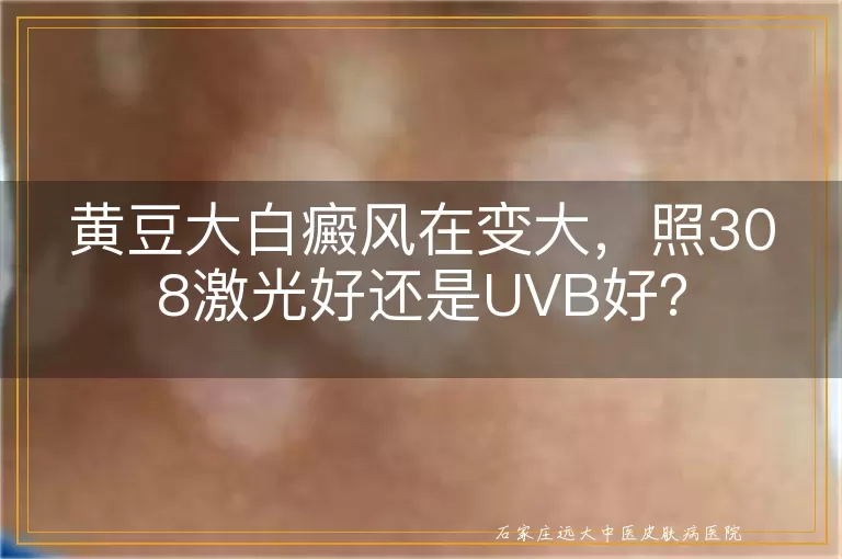 黄豆大白癜风在变大，照308激光好还是UVB好？