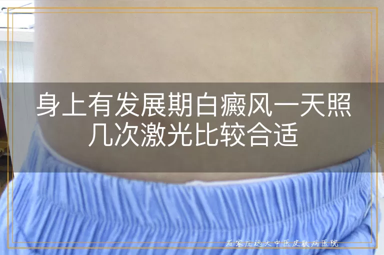 身上有发展期白癜风一天照几次激光比较合适