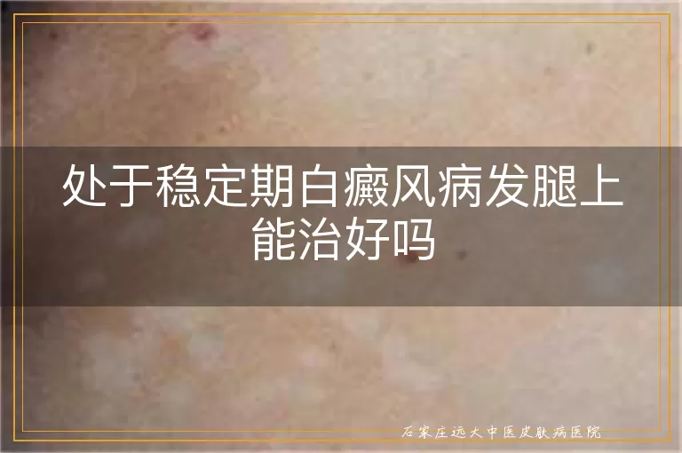 处于稳定期白癜风病发腿上能治好吗