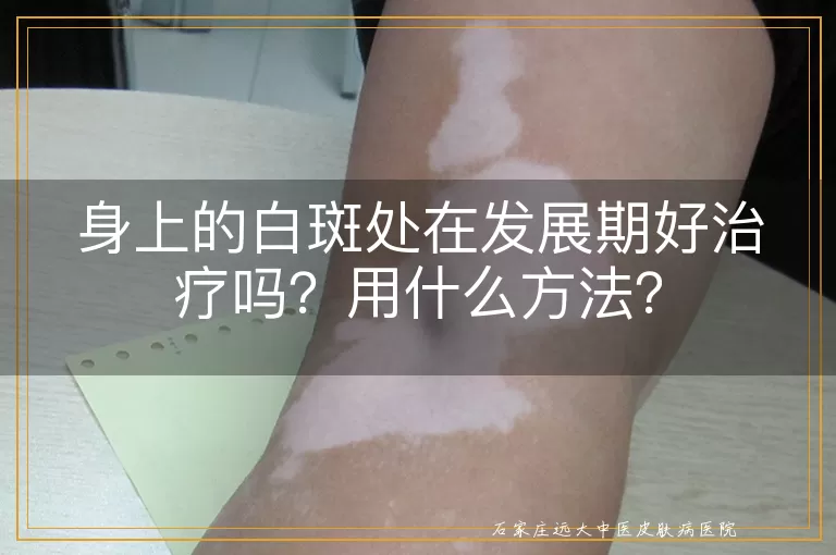 身上的白斑处在发展期好治疗吗？用什么方法？