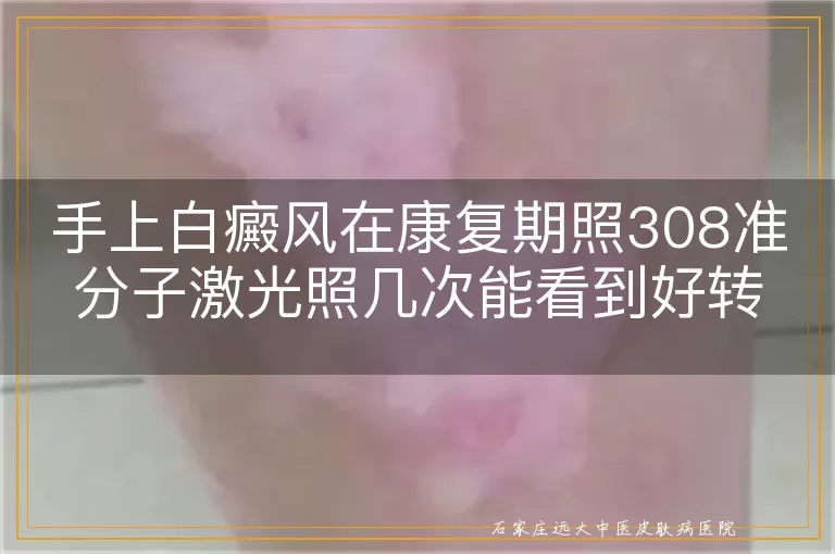 手上白癜风在康复期照308准分子激光照几次能看到好转