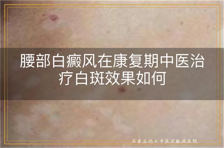 腰部白癜风在康复期中医治疗白斑效果如何