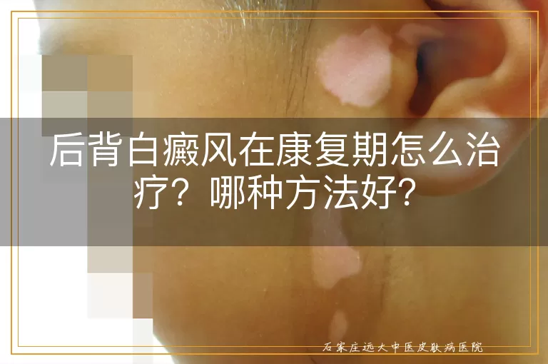 后背白癜风在康复期怎么治疗？哪种方法好？
