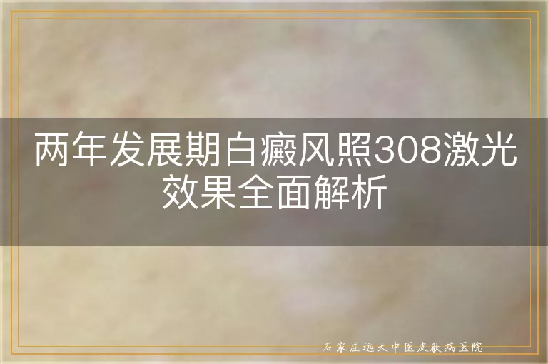 两年发展期白癜风照308激光效果全面解析