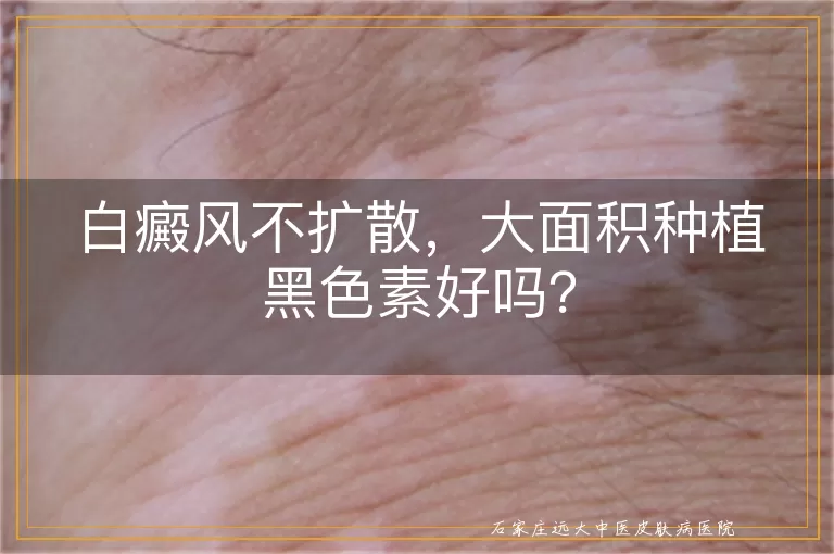 白癜风不扩散，大面积种植黑色素好吗？