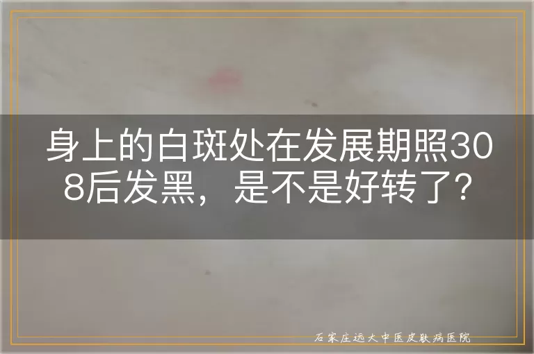 身上的白斑处在发展期照308后发黑，是不是好转了？