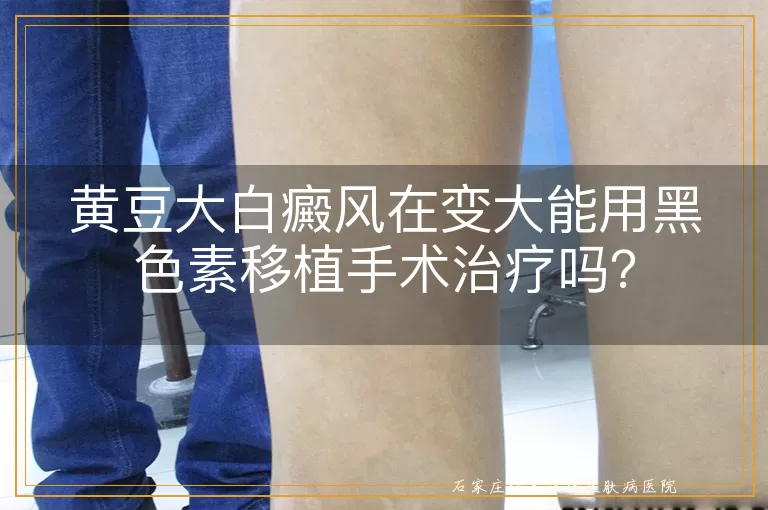 黄豆大白癜风在变大能用黑色素移植手术治疗吗？
