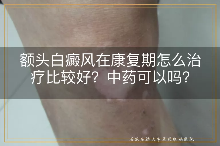 额头白癜风在康复期怎么治疗比较好？中药可以吗？
