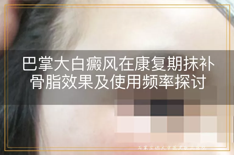 巴掌大白癜风在康复期抹补骨脂效果及使用频率探讨