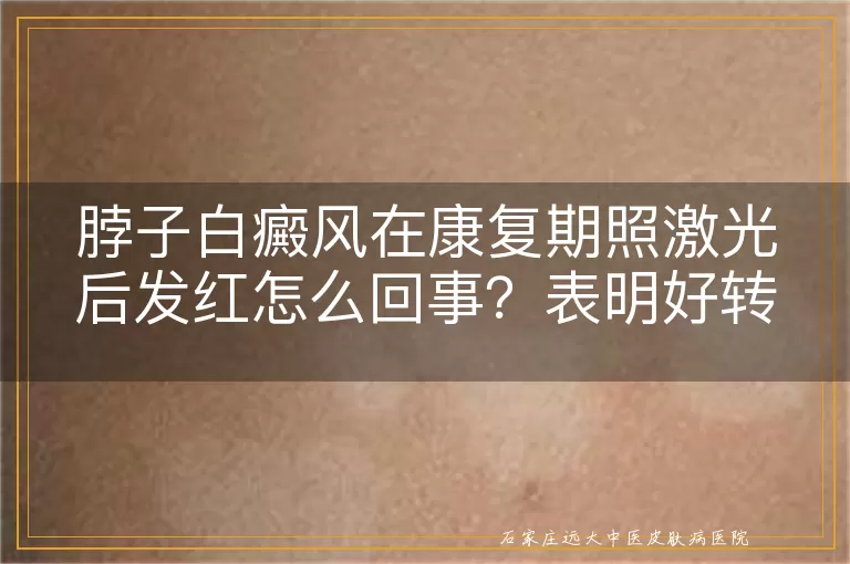 脖子白癜风在康复期照激光后发红怎么回事？表明好转吗？