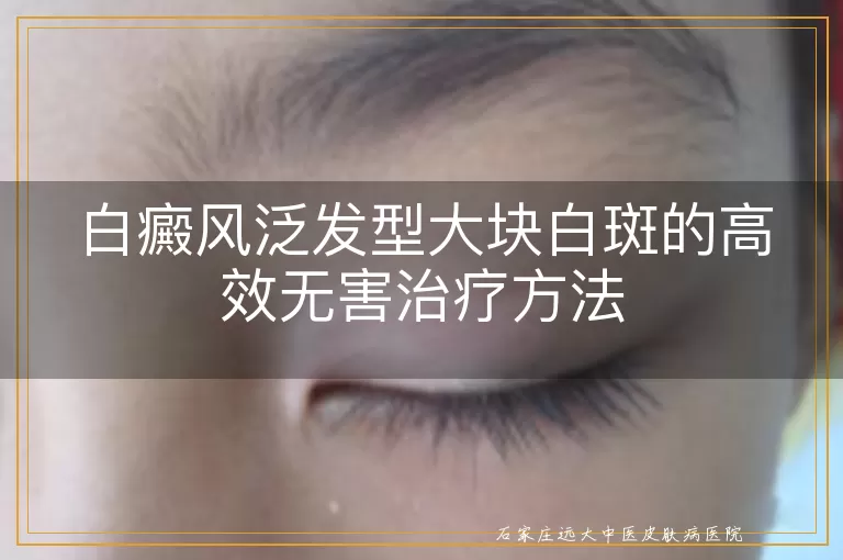 白癜风泛发型大块白斑的高效无害治疗方法