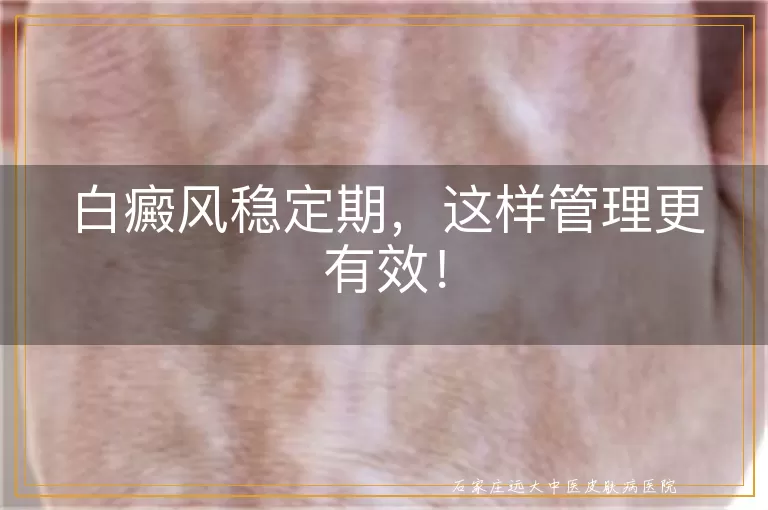 白癜风稳定期，这样管理更有效！