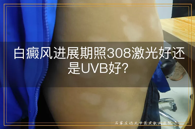 白癜风进展期照308激光好还是UVB好？
