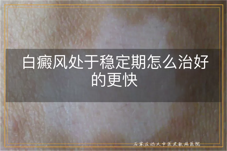 白癜风处于稳定期怎么治好的更快