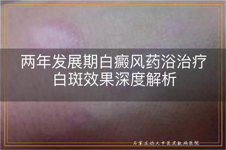 两年发展期白癜风药浴治疗白斑效果深度解析