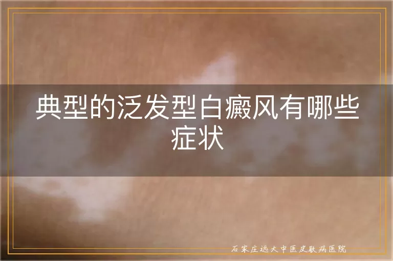 典型的泛发型白癜风有哪些症状