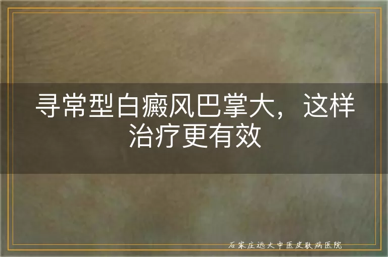 寻常型白癜风巴掌大，这样治疗更有效