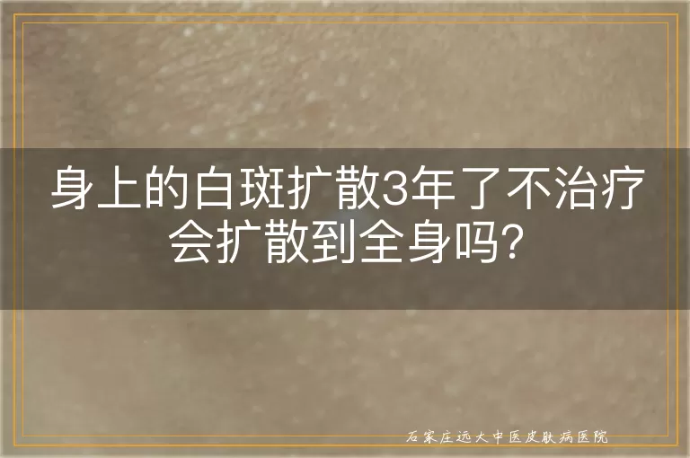 身上的白斑扩散3年了不治疗会扩散到全身吗？