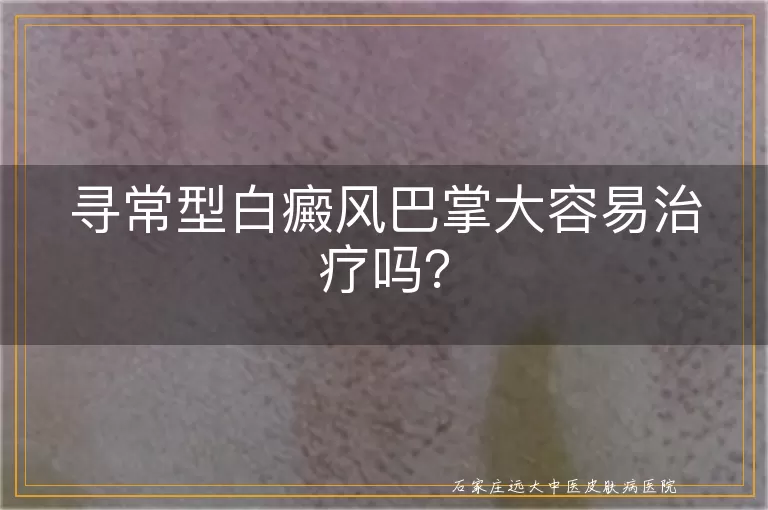 寻常型白癜风巴掌大容易治疗吗？