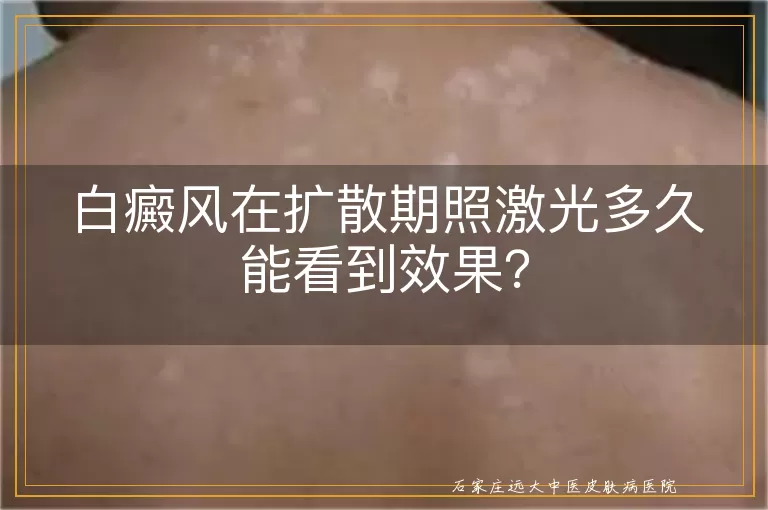 白癜风在扩散期照激光多久能看到效果？