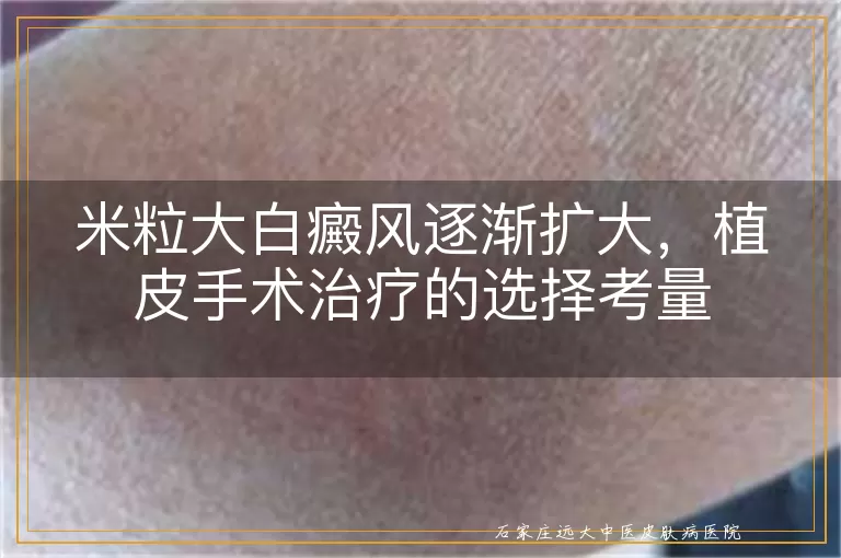 米粒大白癜风逐渐扩大，植皮手术治疗的选择考量