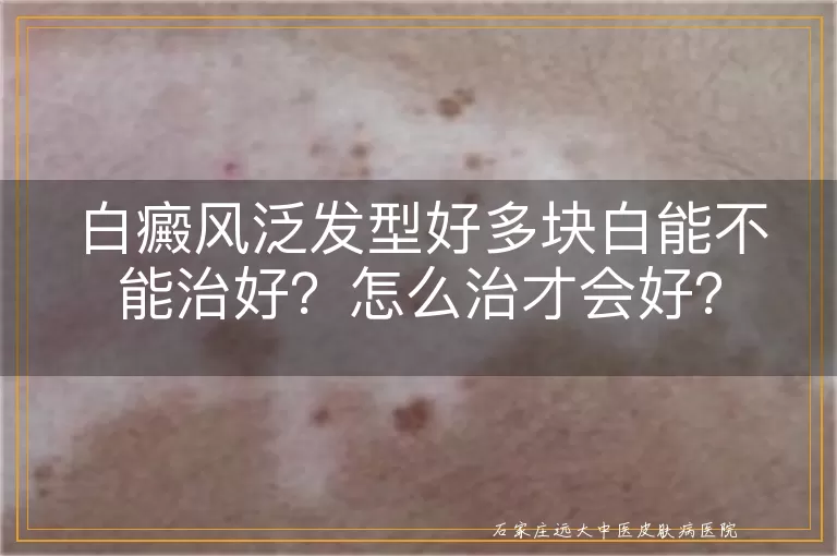 白癜风泛发型好多块白能不能治好？怎么治才会好？