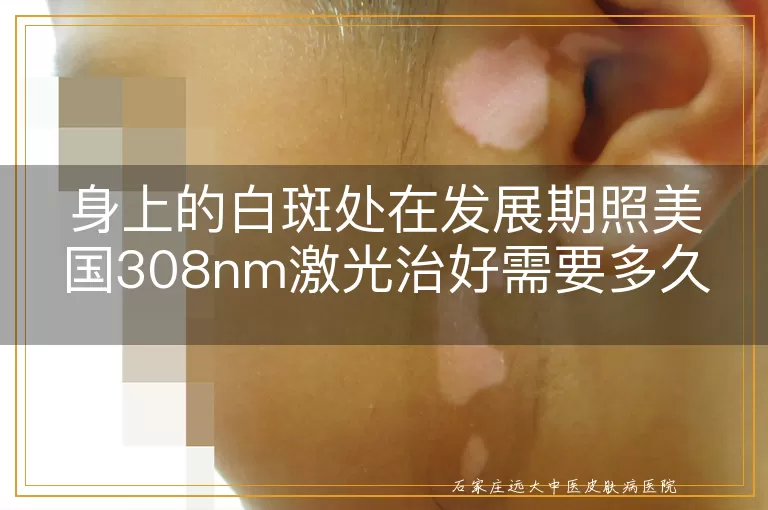 身上的白斑处在发展期照美国308nm激光治好需要多久