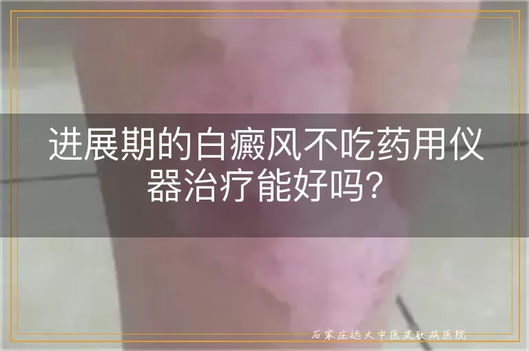 进展期的白癜风不吃药用仪器治疗能好吗？