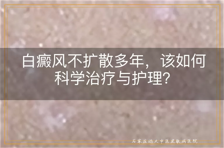 白癜风不扩散多年，该如何科学治疗与护理？