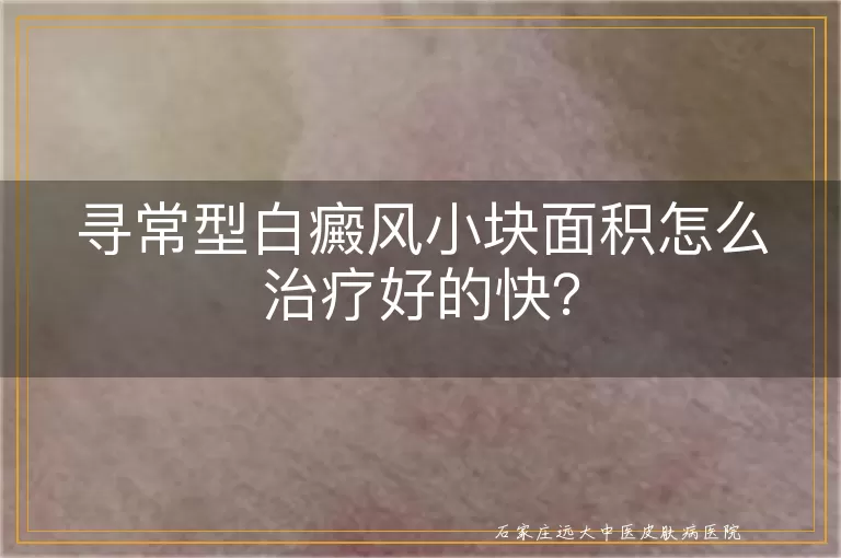 寻常型白癜风小块面积怎么治疗好的快？