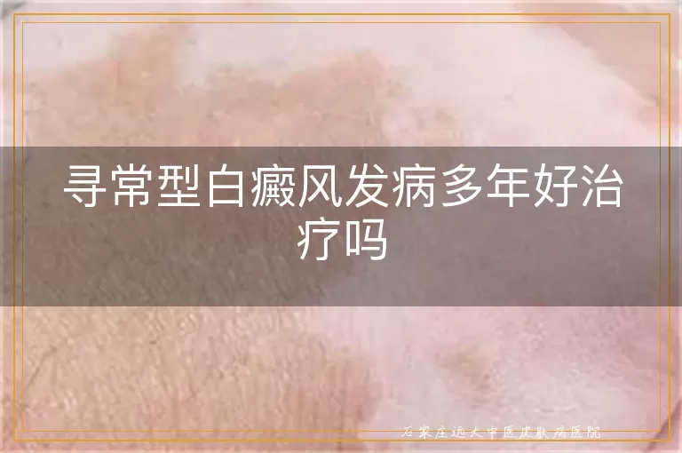 寻常型白癜风发病多年好治疗吗