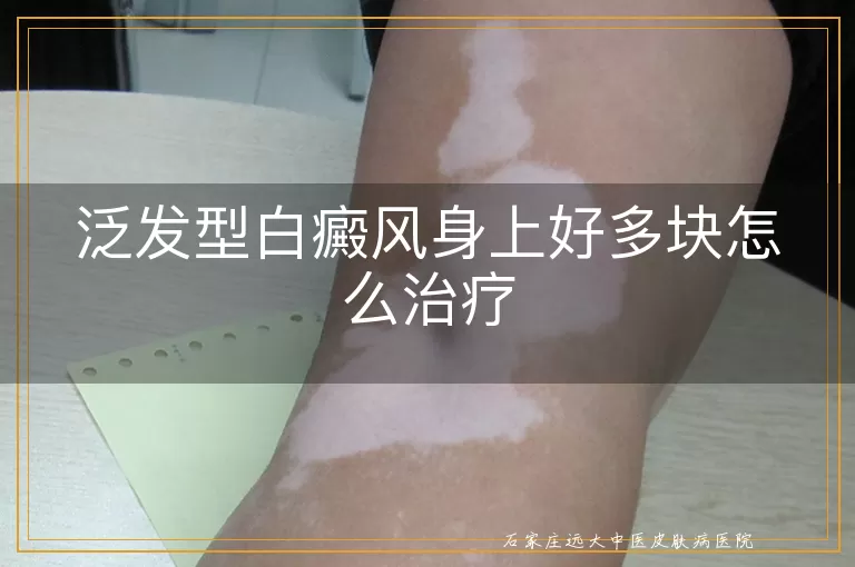 泛发型白癜风身上好多块怎么治疗