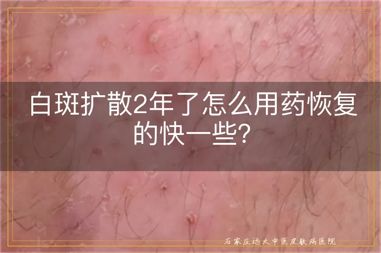 白斑扩散2年了怎么用药恢复的快一些？